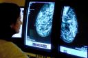 The future outlook for cancer survival rates does not look good if the current trajectory is continued upon (PA)